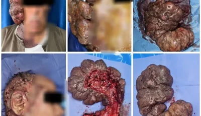 النادرة من نوعها .. فريق طبي بقسم جراحة مستشفى جامعة اسيوط ينجح في إجراء جراحة استئصال ورم ضخم بالوجه لمريض يبلغ من العمر ٧٠ عاما